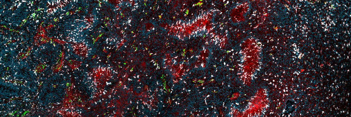 An immunofluorescence image showing glioblastoma with vasculature (red), and immune cells infiltrating regions of necrosis An immunofluorescence image showing glioblastoma with vasculature (red), and immune cells infiltrating regions of necrosis