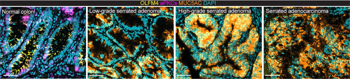 A four-panel image showing cells of a healthy intestinal mucosa (panel 1), premalignant adenoma gradually developing into a cancerous tumor (panel 2-4). A four-panel image showing cells of a healthy intestinal mucosa (panel 1), premalignant adenoma gradually developing into a cancerous tumor (panel 2-4).