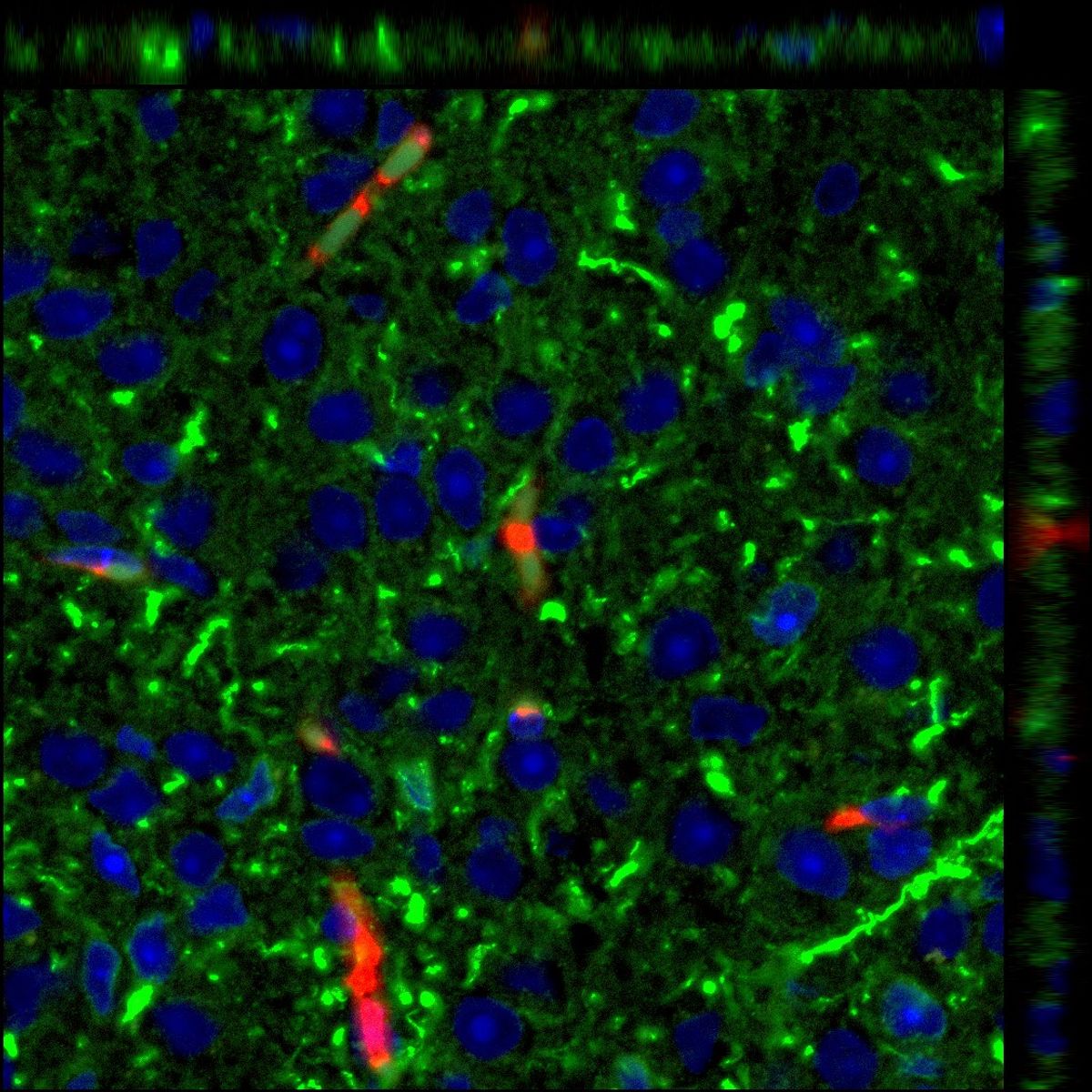 Neurons (green) taking up breast cancer extracellular vesicles (red). Neurons (green) taking up breast cancer extracellular vesicles (red).