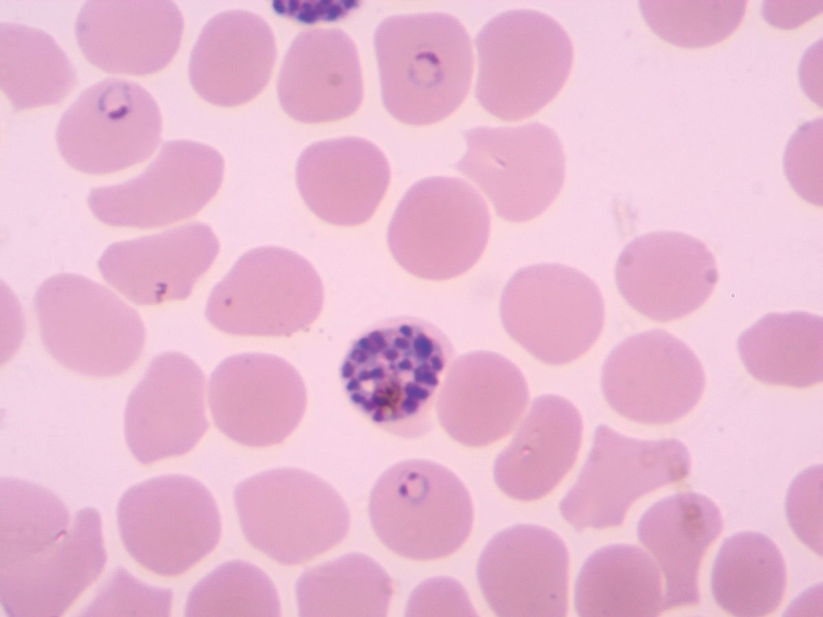 Red blood cells infected with Plasmodium falciparum parasites. Red blood cells infected with Plasmodium falciparum parasites.