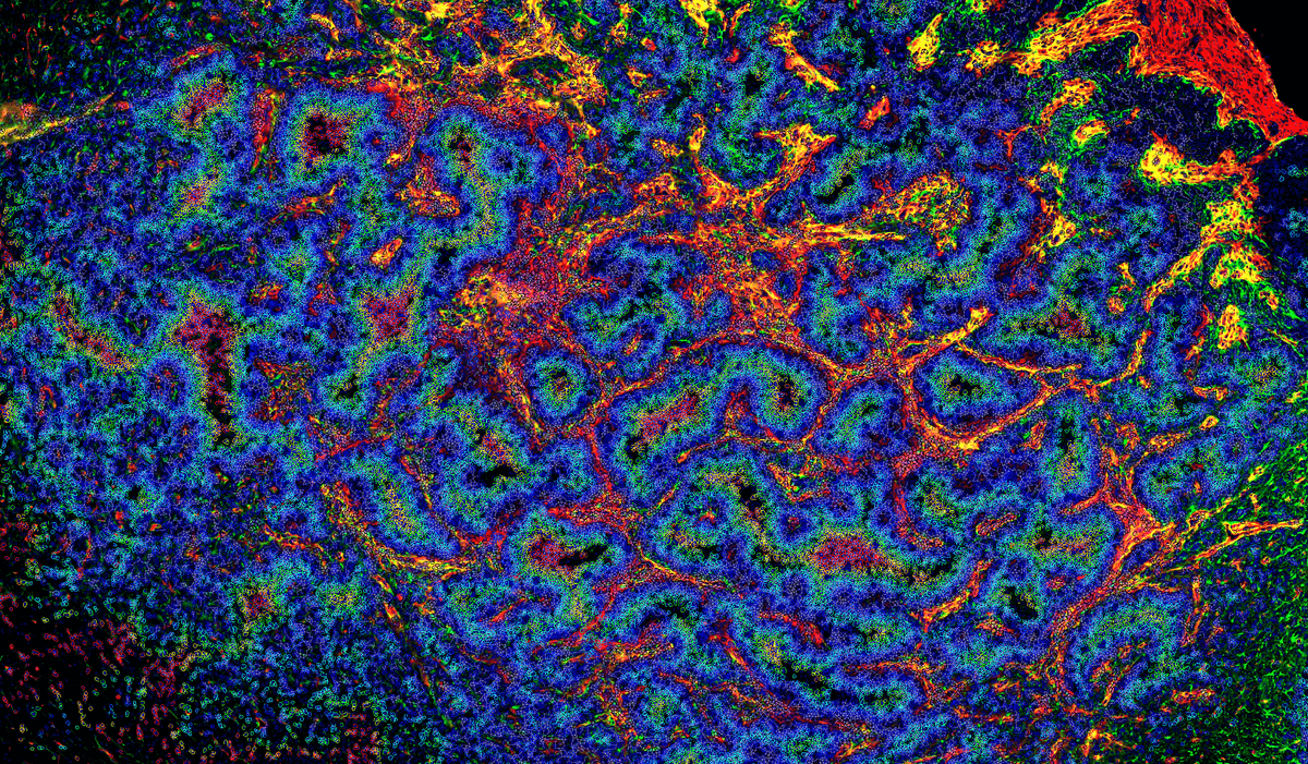 A colorful micrograph showing a glioblastoma, with areas of necrosis, infiltrating immune cells, and vascularization. A colorful micrograph showing a glioblastoma, with areas of necrosis, infiltrating immune cells, and vascularization.