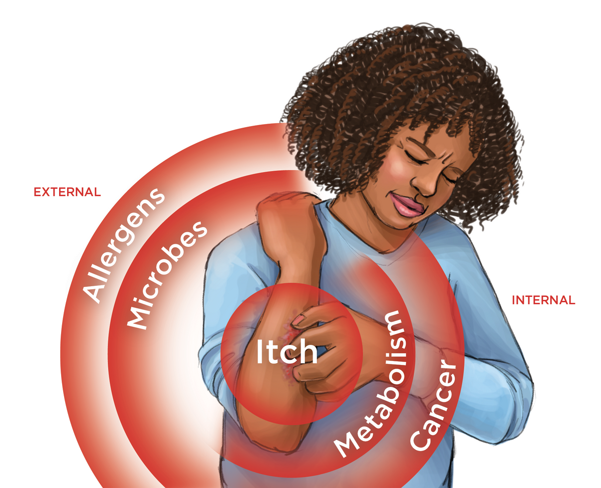 Illustration comparing external and internal reasons for an itch. Illustration comparing external and internal reasons for an itch.